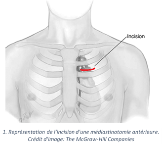 Mediastinotomie_anterieure_Chamberlain