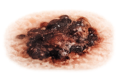 Melanom-1