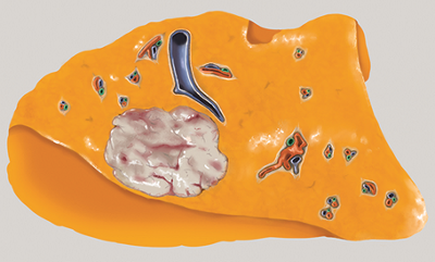 Eine Metastase in der Leber, wie sie sich dem Chirurgen nach operativer Entfernung zeigt.