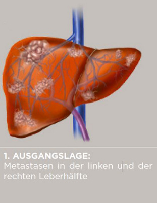 Metastasen_Ablauf_Leber_1