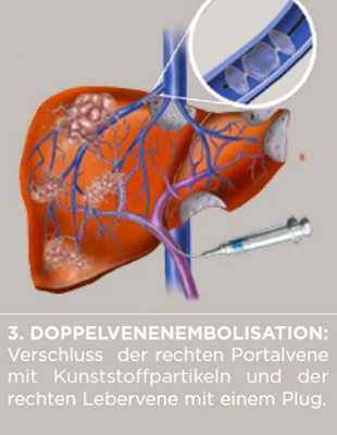 Metastasen_Ablauf_Leber_3