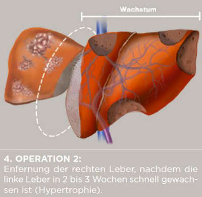 Metastasen_Ablauf_Leber_4