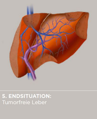 Metastasen_Ablauf_Leber_5