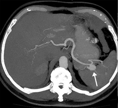 Milzarterienaneuysma