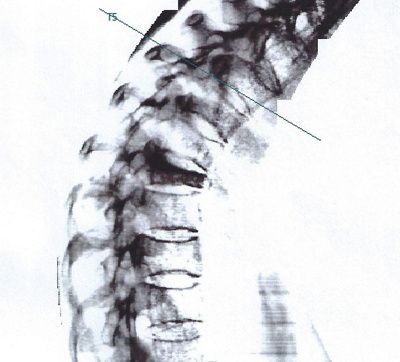 Wirbelsäule durch Ultraschall