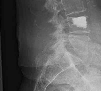 Wirbelsäule durch Ultraschall