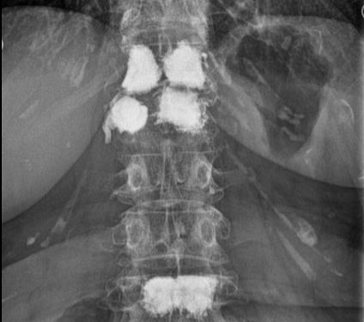 Wirbelsäule durch Ultraschall