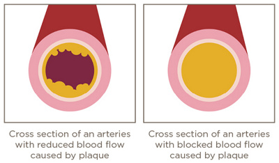 PAVK_English_Image_2_Final