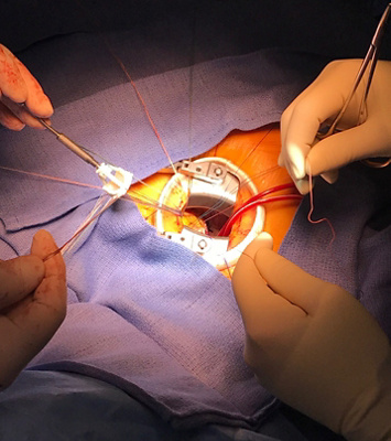 Photo intraop MICS valve_carré