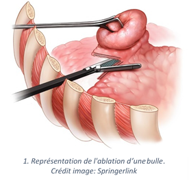Pleurodese_mecanique