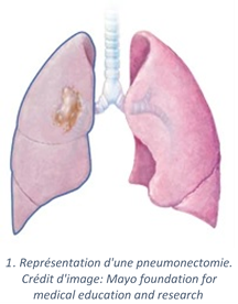 Pneumonectomie