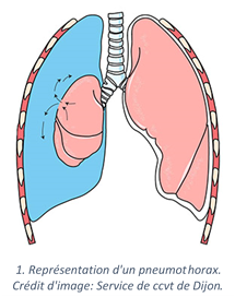 Pneumothorax