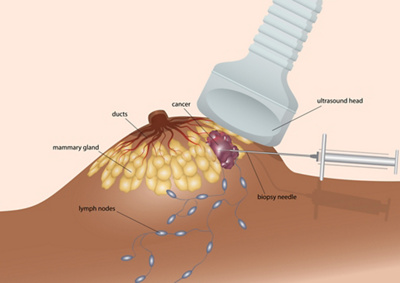 breast lump removal graphic