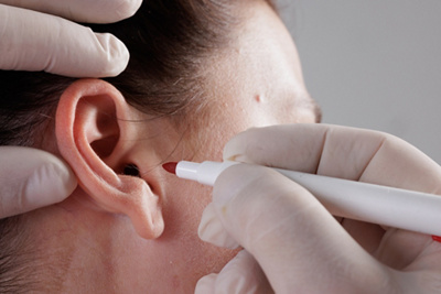 ear otoplasty