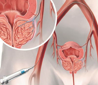 Prostataarterienembolisation