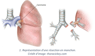 Resection_manchon