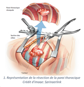 Resection_paroi_thoracique