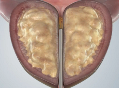 Erklärungsvideo RezumTM-Therapie