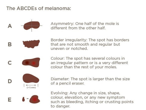 The ABCDEs of spotting melanoma