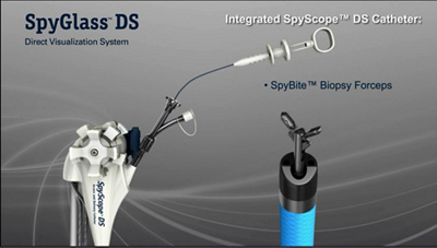 SPYGLASS– ERCP WITH SPYSCOPE