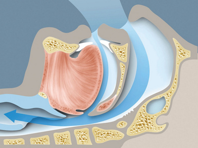 Schlafapnoe_normalsituation