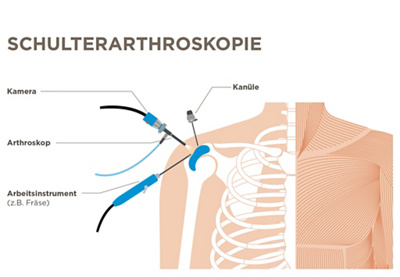 Schulter, Abbildung von Schultergelenk