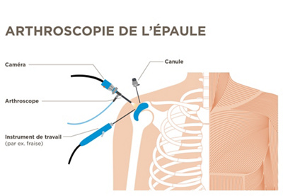 Épaule, illustration de l'articulation de l'épaule