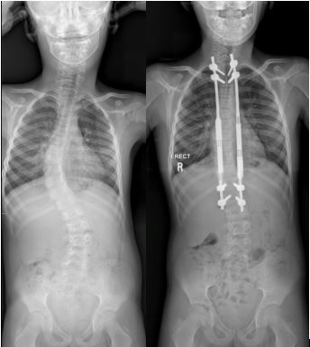 Scoliosis2