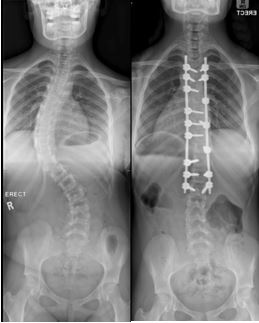 Scoliosis3