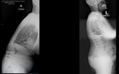 Scoliosis4