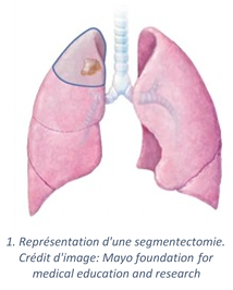 Segmentectomie