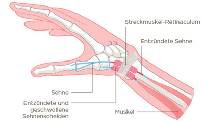Visualisierung Sehnenscheidenentzündung