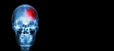 Staying ahead of epilepsy