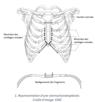 Sternochondroplastie