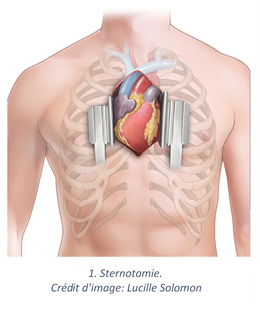 Sternotomie