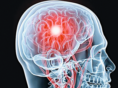 Stroke Bild Schaedel