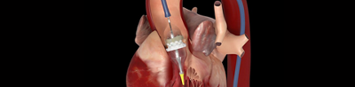 Mediclinic Panorama TAVI Programme advances patient care