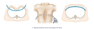 Technique_Nuss