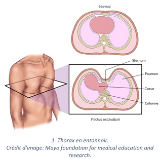 Thorax_entonnoir