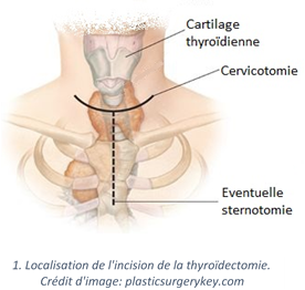 Thyroidectomie