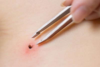 Tick bites - symptoms, treatments and prevention