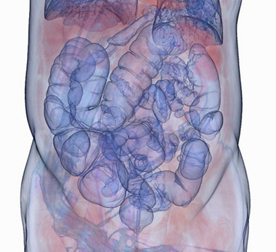 Virtual colonoscopies are a valuable cancer screening tool