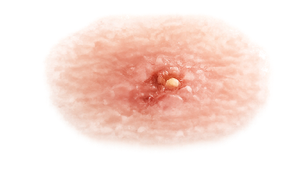Weisser_Hautkrebs_Typ_1