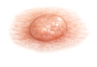 Weisser_Hautkrebs_Typ_2