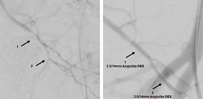 abbildung_1_diehm_angio