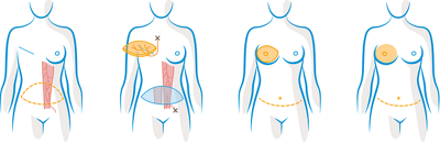 Abbildung: Gewebe aus dem Unterbauch zum Wiederaufbau der Brust