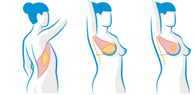 Abbildung: Gewebe aus dem Rücken zum Wiederaufbau der Brust