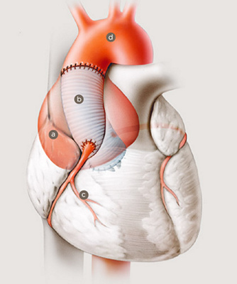 aneurysma_aorta_ascendens