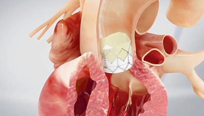 aortenklappenprothese_implantiert