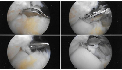 arthroskopie_sprunggelenk